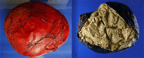 A, Intact, resected cystic specimen with a red, smooth, and glistening external surface; B, cut section of the resected mass revealing a mixture of yellow-gray granular material, hair follicles, and friable keratin debris with adipose tissue