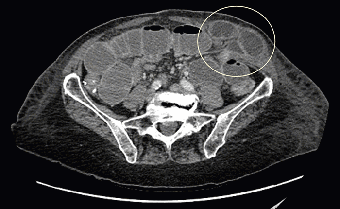 Axial contrast-enhanced CT scan of the abdomen and pelvis obtained on POD 5. This image clearly depicts a high-grade small bowel obstruction caused by a segment of jejunum herniating through the fascial defect at the site of the prior left anterior axillary line 6 mm port