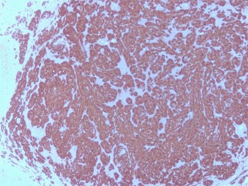 A. Histological findings of the tumor showing positive immunoreaction for S-100 protein