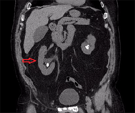Figure 4. Coronal view of same study showing bilateral renal calculi with significant right sided hydronephrosis 