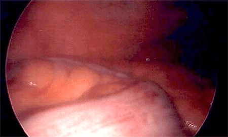 Figure 5. Laparoscopic view of descending colon on the right and cecum in the middle