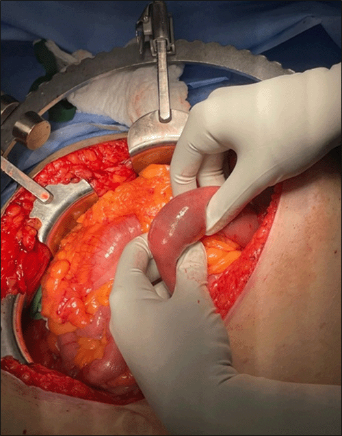 A) Endoscopic visualization of a gallstone within the proximal jejunum