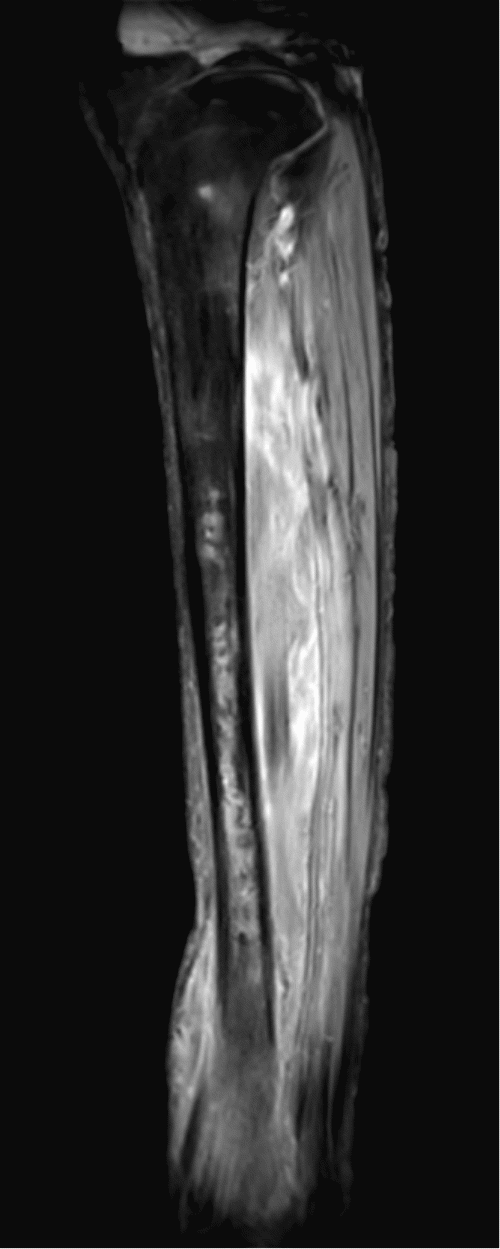 D) Sagittal T1 fat-suppressed gadolinium-enhanced MRI showing heterogeneous distal tibial bone marrow enhancement and diffuse intramuscular enhancement