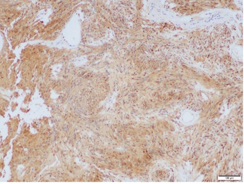 S-100 positivity on immunohistochemical staining confirms diagnosis of gastric schwannoma