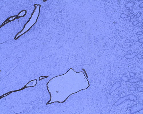 A) Immunostaining Profile, Demonstrating Endometriosis: CK7