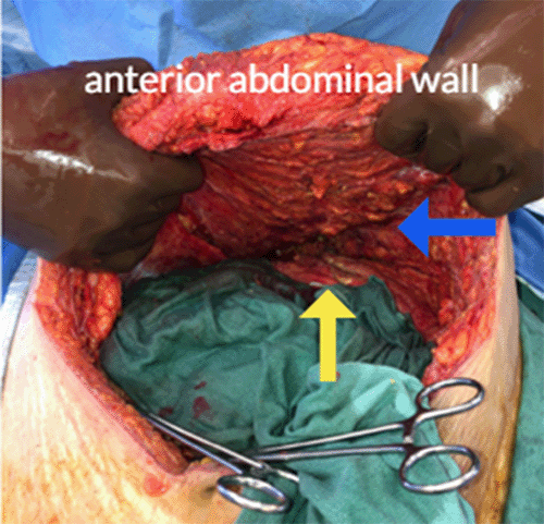 Note retracted abdominal wall musculature (yellow arrow) away from overlying subcutaneous tissue (blue arrow), creating significant potential space