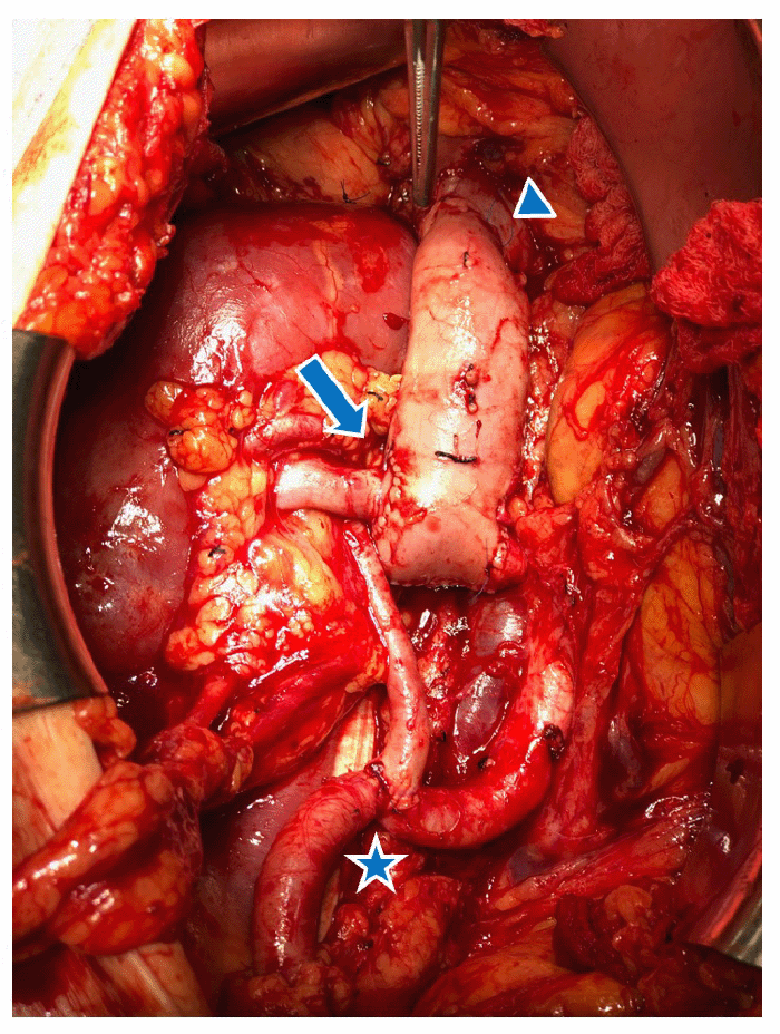End-to-side donor renal vein to donor IVC conduit anastomosis (arrow). End-to-side donor IVC to recipient IVC anastomosis (arrowhead). Conventional end-to-side donor renal artery to recipient external iliac anastomosis (star)