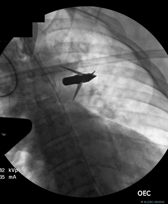 Figure 2. Intraoperative fluoroscopy image