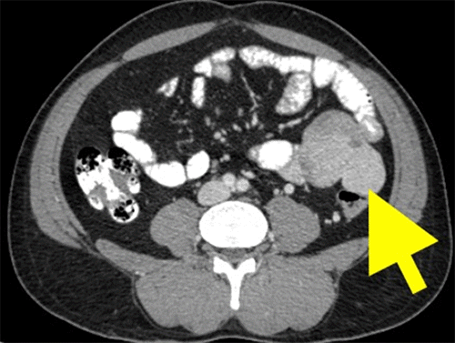 Scan demonstrates a soft tissue mass lesion located in the left lumbar region, with infiltration into the descending colon