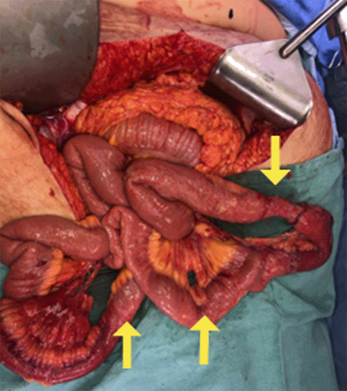 Note associated mesenteric defects (bucket handle injuries) indicated by yellow arrows 