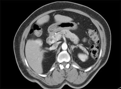 Figure 1. CT abdomen demonstrating 2.9 x 2.7 cm enhancing mass in the pancreatic head, multiple cystic structures within the pancreas for which intraductal papillary mucinous neoplasm is not excluded. 