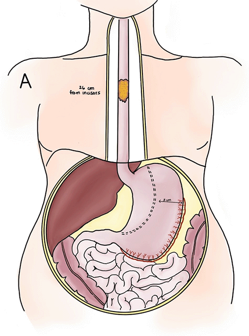 A) Preoperative: Depiction of esophageal squamous cell carcinoma located 26 cm from the incisors. A 5 cm gastric conduit is planned, preserving the right gastroepiploic artery for vascular supply.