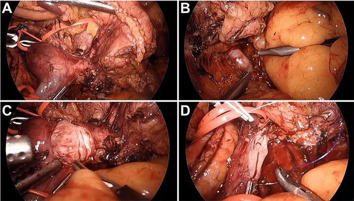 Tumor thrombus located A) at the splenoportal confluence and B) within the inferior mesenteric vein. C) Intraoperative view during venotomy at the junction of the splenic vein, facilitating the extraction of the tumor thrombus. D) Laparoscopic reconstruction of the portal vein following tumor thrombus removal