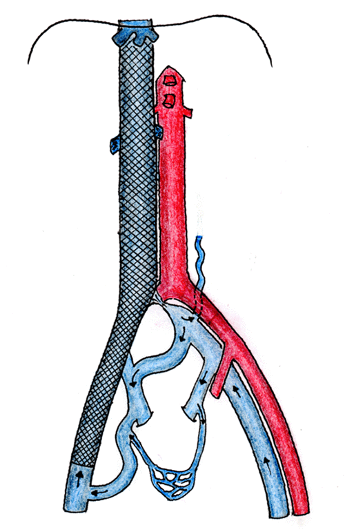 B) Left CIV is occluded and drains through the right IIV to the EIV and eventually through the recanalized IVC (author illustration).