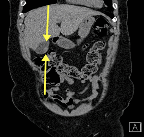 (B) Coronal CT image demonstrating focal thickening of the gallbladder wall without pericholecystic stranding