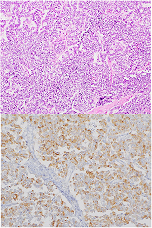 Figure 4: Final pathology showing glucagon and somatostatin-producing PNET, above image is H&E stain at 10x magnification, below image is glucagon stain at 20x magnification.