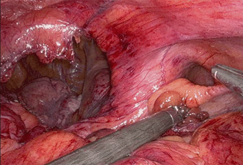 Intraoperative photographs depicting the anterior diaphragm with bilateral Morgagni hernia defects. The larger right-sided defect is shown containing herniated loops of small bowel, while the left-sided defect contained omentum prior to reduction