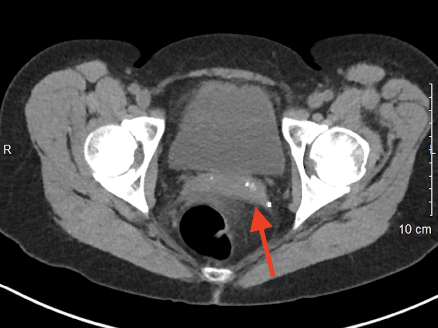 CT of Pelvis Demonstrating Free Blood Around Rectum (arrow).