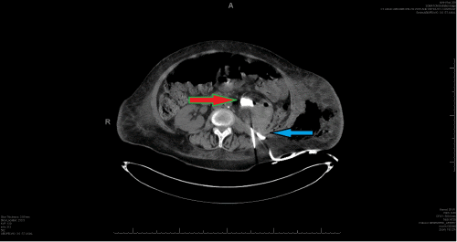 D) Status postpercutaneous left nephrostomy (red arrow) and catheter drainage of the left retroperitoneal abscess (blue arrow)