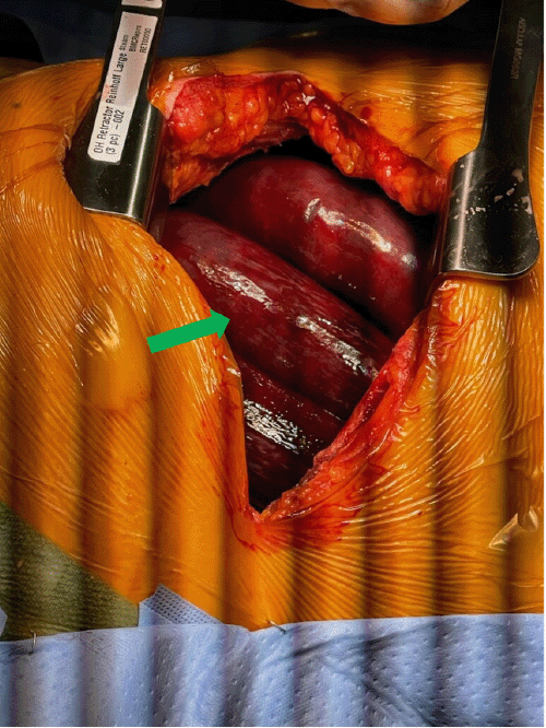 Intraoperative photograph from thoracotomy exploration showing ischemic and necrotic-appearing small bowel in the right thoracic cavity (green arrow)