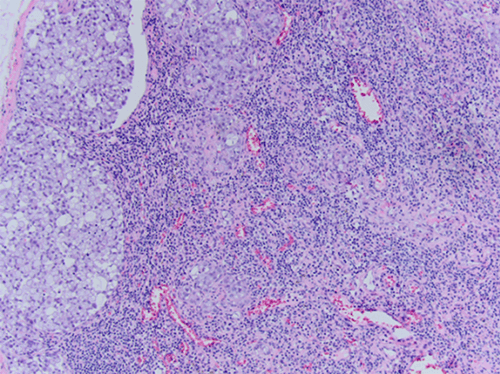 Signet Ring Cell Carcinoma of the Breast: An Aggressive Tumor | ACS