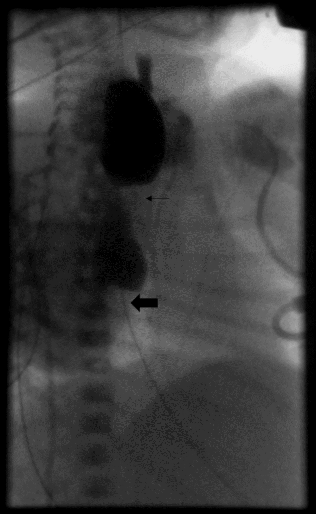 Figure 3. Esophagram performed under fluoroscopy shows narrowing at the esophageal anastomosis (small arrow), with a second area of distal stricture (big arrow) with proximal distension. There was very slow passage of a small amount of contrast into the stomach.