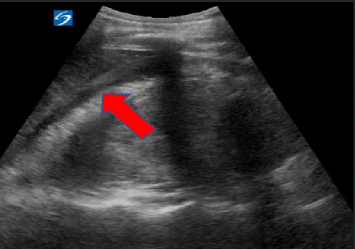 B) Fluid collection in the right upper quadrant