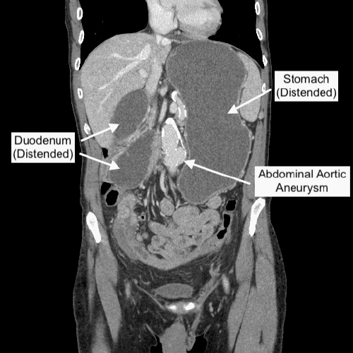 Coronal view from a contrast-enhanced CT scan of the abdomen. The image shows significant dilatation of the stomach and proximal duodenum with an abrupt transition point at the level of the transverse duodenum, consistent with a high-grade small bowel obstruction. Note the abnormal displacement of distal duodenal and proximal jejunal loops into the right abdomen. An adjacent calcified abdominal aortic aneurysm is also partially visualized