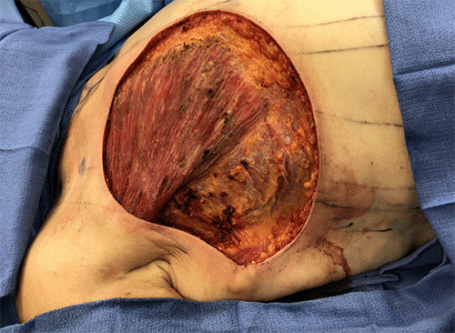 Large tissue defect following total mastectomy