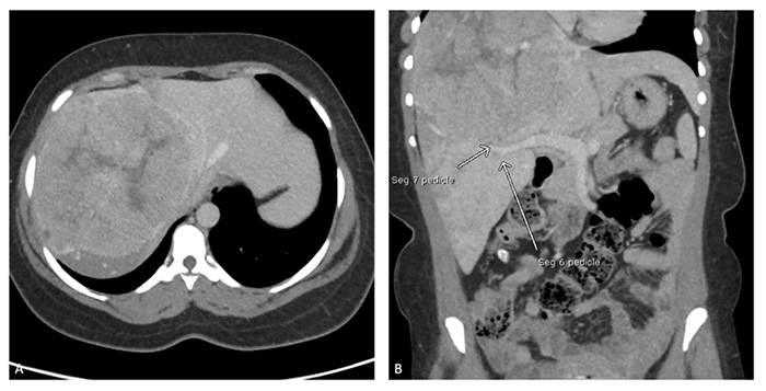 (A) Axial view demonstrating a large, centrally located hepatocellular carcinoma. (B) Coronal view showing the vascular pedicles to segments 6 and 7 (white arrows)