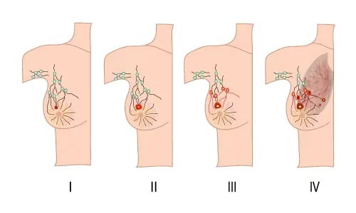 Types of Breast Cancer