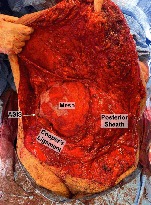 Intraoperative photograph demonstrating the placement of the BARD® Midweight monofilament polypropylene mesh (26 × 30 cm) in the retrorectus underlay position, secured to surrounding ligamentous and bony structures.