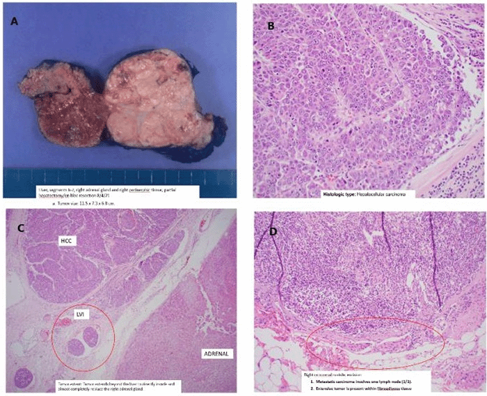 (A) Tumor measuring 11.5 × 7.3 × 6.8 cm; (B) moderately to poorly differentiated hepatocellular carcinoma; (C) extrahepatic tumor extension with direct invasion and near-complete replacement of the right adrenal gland; (D) a satellite nodule with metastatic carcinoma involving one lymph node and extensive tumor within the fibroadipose tissue
