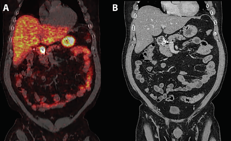 A. Coronal Ga-68 PET/CT demonstrated high standardized uptake value associated with the primary duodenal NET not visible in normal CT; B. Coronal CT image demonstrating artifact created by gastroduodenal artery coils placed during acute GI bleeding thought to be secondary to peptic ulcer disease