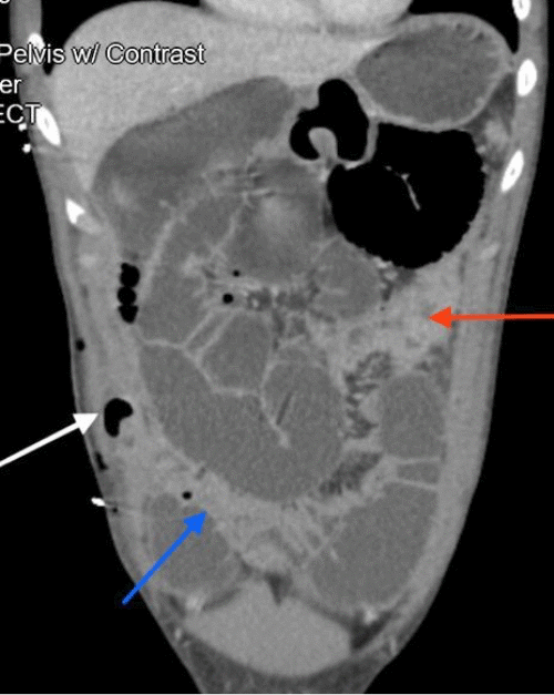 (B) Axial view showing the collapsed bowel originating proximal to the ileocolic anastomosis (blue arrow)
