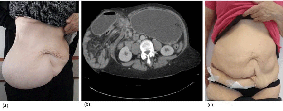 A) Preoperative Physical Examination; B) CT Scan; C) Physical Examination One-Week Postoperative