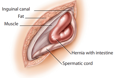 Pediatric Hernia - Inguinal and Femoral Repair