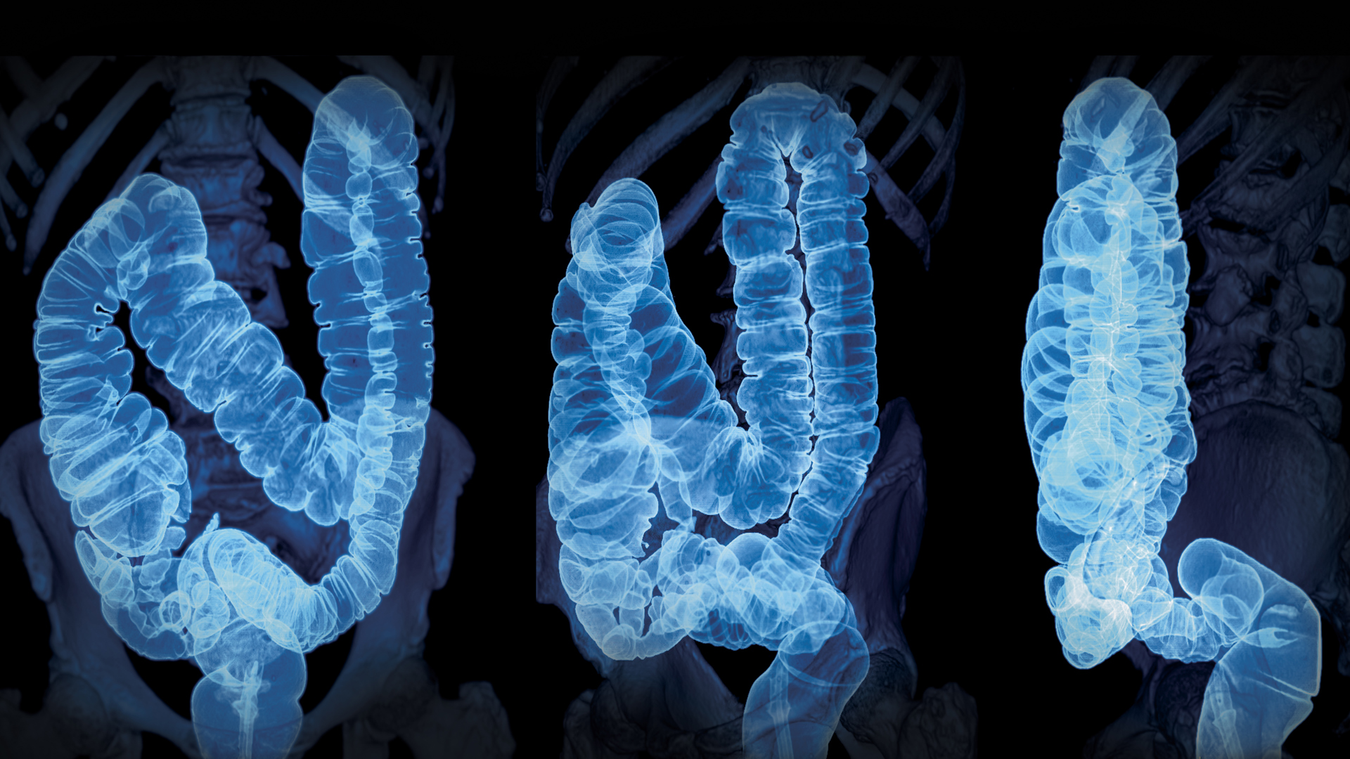 Diverticulitis Experts Will Challenge Dogma, Tackle Tough Cases