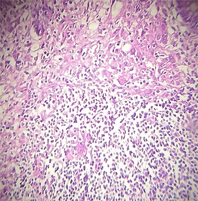 Figure 1. Granulomatous appendicitis, Submucosa granulomas surrounded by necrotic center around histiocytes.