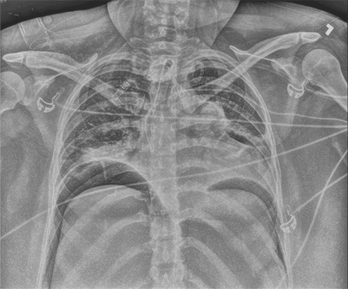 Right mainstem tracheostomy and free intraperitoneal air under bilateral hemidiaphragm is indicated