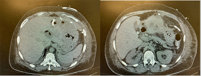 Axial contrast-enhanced CT scan of the abdomen obtained POD 4. The image shows resolution of the previously noted pneumoperitoneum. A well-defined fluid collection consistent with an abscess is now evident in the left hepatic lobe. Note the presence of a newly placed percutaneous interventional radiology drain within the hepatic abscess (left-sided drain) and the surgically placed intra-abdominal drain (right-sided drain)