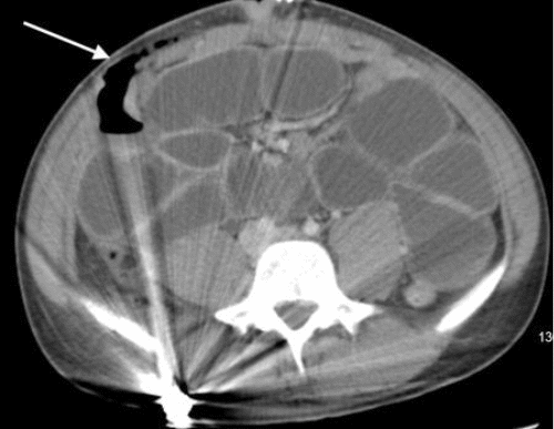Axial view demonstrating the transition point abutting the fascial defect in the abdominal wall