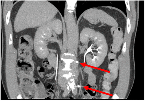 Coronal reformatted CT scan obtained after percutaneous, image-guided placement of MOLLI Markers®. The image demonstrates the precise positioning of the magnetic seeds (arrows) bracketing the recurrent para-aortic lesion, confirming their suitability for intraoperative localization