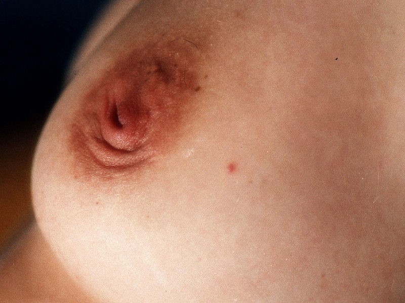 Non-Invasive Breast Cancers