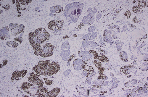 (B) Ki-67 stain (40x magnification) showing a high proliferation index within the adenocarcinoma component and a significantly lower proliferation index in the neuroendocrine component