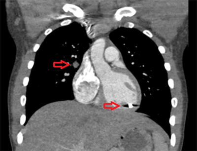 Figure 3. Coronal view demonstrating bullet track and foreign body inside the left ventricle.