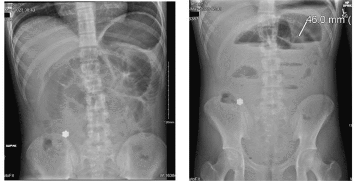(Left) Supine and (right) upright abdominal radiographs demonstrating dilated loops of small bowel with multiple air-fluid levels, indicative of small bowel obstruction