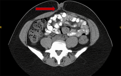 Axial view from a non-contrast CT scan of the abdomen and pelvis. The image shows a fat-containing umbilical hernia (arrow) with associated soft tissue nodularity at the umbilicus, findings which, in conjunction with the clinical history, were suspicious for an umbilical endometrioma