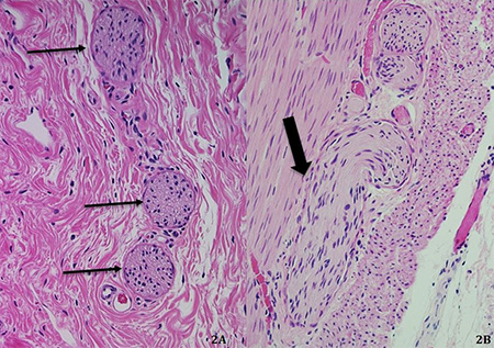 Figure 2a and 2b. Rectosigmoid aganglionosis (Hirschsprung disease)- Hypertrophic nerves are present in the submucosa (thin arrows, fig 2A, HE stain, x200) and muscularis propria (bold arrow, 2B, HE stain, x200). NO submucosal or myenteric ganglion cells are seen (2A and 2B, HE stain, x200).