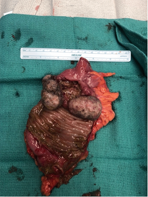 B) opening of the resected segment of the colon showing multiple separate polypoid masses